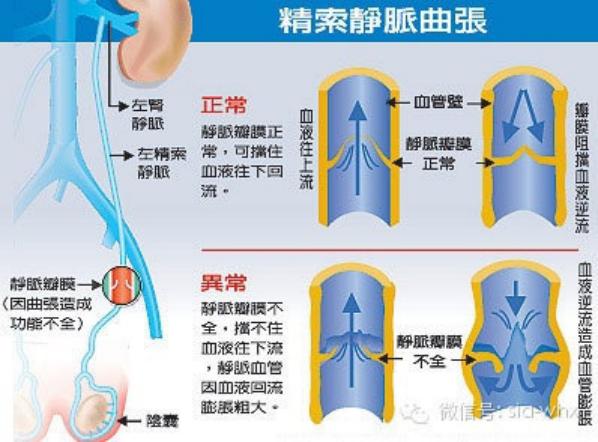 關于2021年征兵精索靜脈曲張標準的探討，2021年征兵精索靜脈曲張標準深度解析